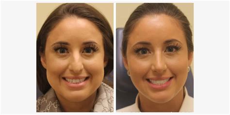 buccal fat removal norge pris|Best pris på Fjerne fettkul .
